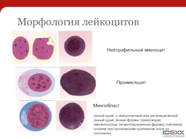 Морфология лейкоцитов Нейтрофильный миелоцит Промиелоцит Миелобласт левый сдвиг с нейтропенией