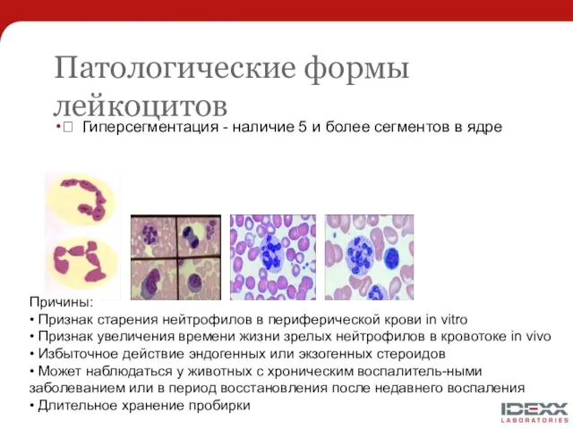 Патологические формы лейкоцитов  Гиперсегментация - наличие 5 и более