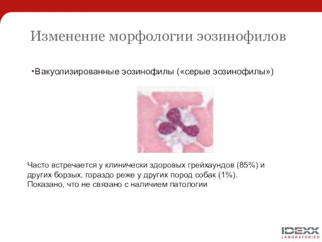 Изменение морфологии эозинофилов Вакуолизированные эозинофилы («серые эозинофилы») Часто встречается у