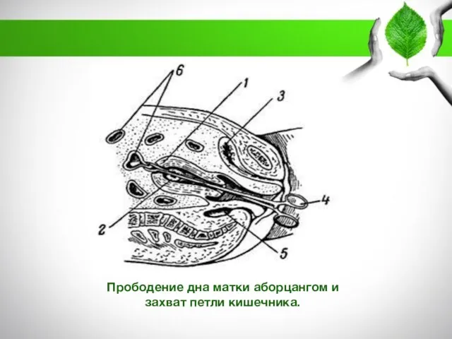 Прободение дна матки аборцангом и захват петли кишечника.