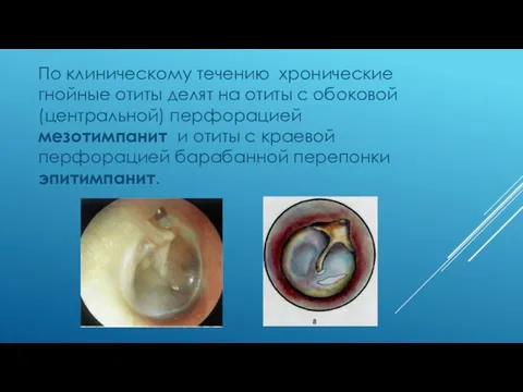 По клиническому течению хронические гнойные отиты делят на отиты с обоковой (центральной) перфорацией