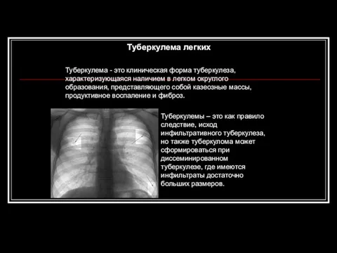 Туберкулема легких Туберкулема - это клиническая форма туберкулеза, характеризующаяся наличием