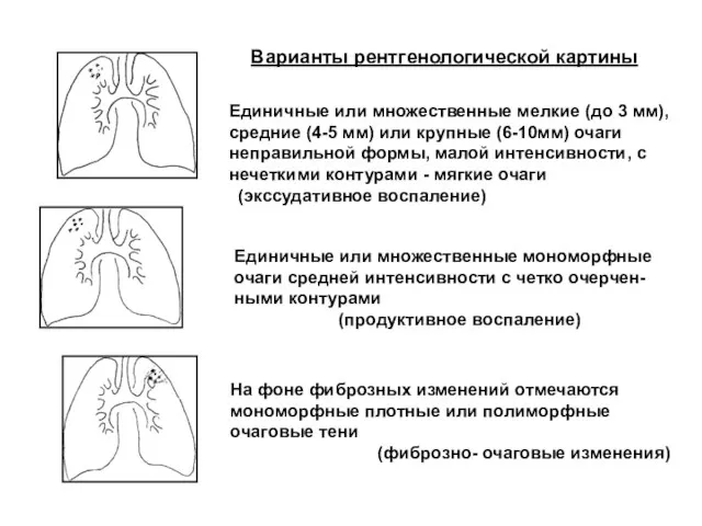 Варианты рентгенологической картины Единичные или множественные мелкие (до 3 мм),