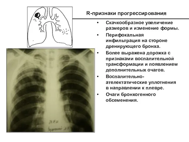 R-признаки прогрессирования Скачкообразное увеличение размеров и изменение формы. Перифокальная инфильтрация