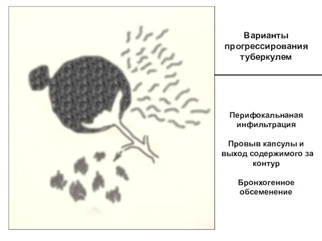 Варианты прогрессирования туберкулем Перифокальнаная инфильтрация Провыв капсулы и выход содержимого за контур Бронхогенное обсеменение