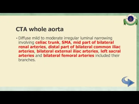 CTA whole aorta Diffuse mild to moderate irregular luminal narrowing