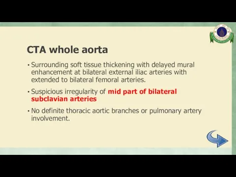 CTA whole aorta Surrounding soft tissue thickening with delayed mural