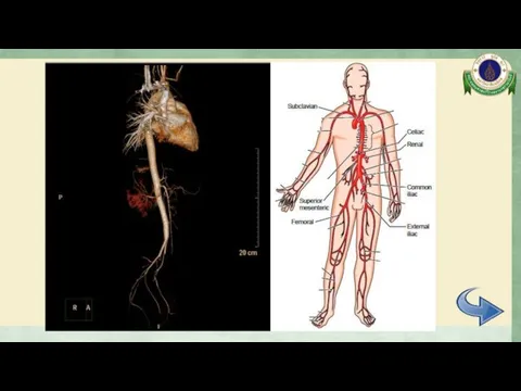 CTA whole aorta