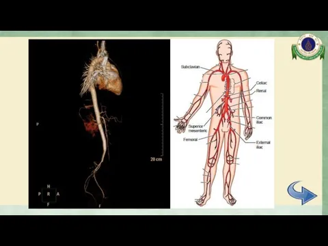 CTA whole aorta