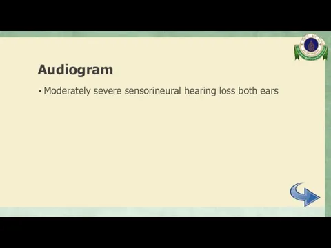 Audiogram Moderately severe sensorineural hearing loss both ears