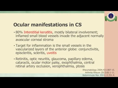 Ocular manifestations in CS 80% Interstitial keratitis, mostly bilateral involvement;