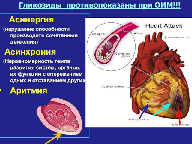 Гликозиды противопоказаны при ОИМ!!! Асинергия (нарушение способности производить сочетанные движения)