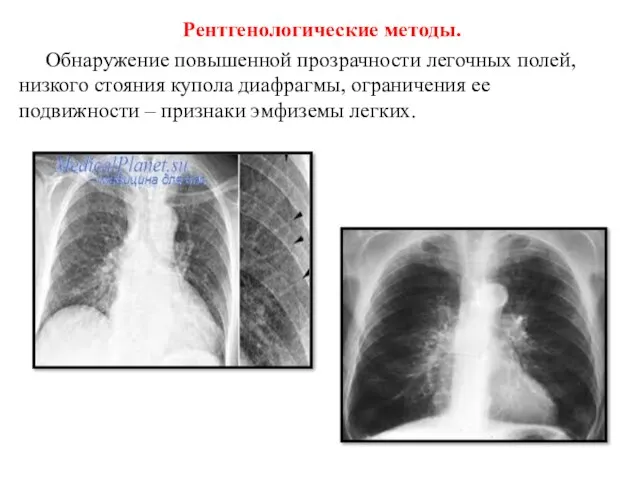 Рентгенологические методы. Обнаружение повышенной прозрачности легочных полей, низкого стояния купола