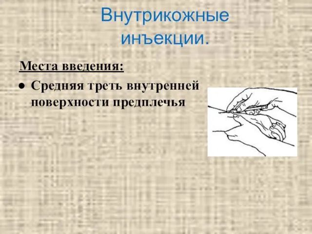 Внутрикожные инъекции. Места введения: Средняя треть внутренней поверхности предплечья