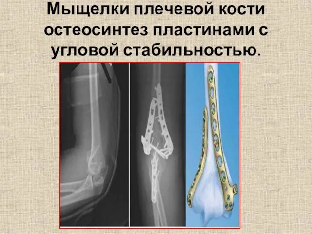 Мыщелки плечевой кости остеосинтез пластинами с угловой стабильностью.