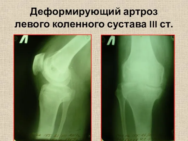 Деформирующий артроз левого коленного сустава III ст.
