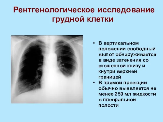 В вертикальном положении свободный выпот обнаруживается в виде затенения со