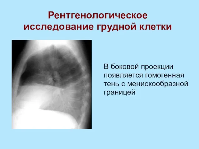 В боковой проекции появляется гомогенная тень с менискообразной границей Рентгенологическое исследование грудной клетки