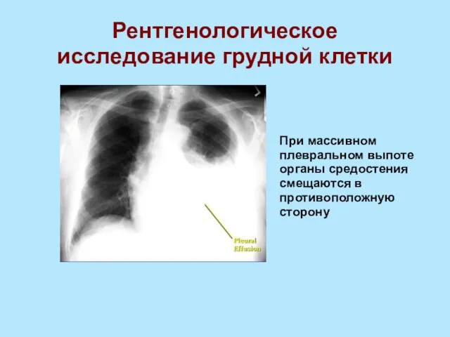 Рентгенологическое исследование грудной клетки При массивном плевральном выпоте органы средостения смещаются в противоположную сторону
