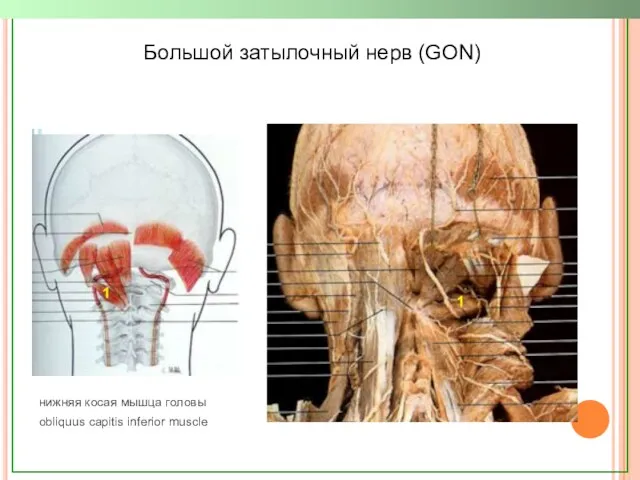 Большой затылочный нерв (GON) нижняя косая мышца головы obliquus capitis inferior muscle