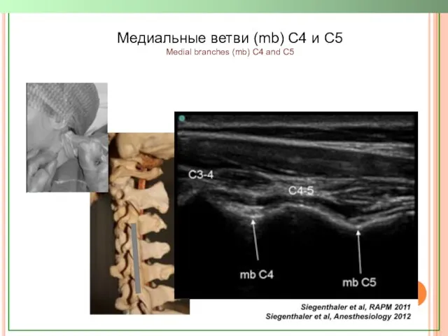Медиальные ветви (mb) C4 и C5 Medial branches (mb) C4 and C5
