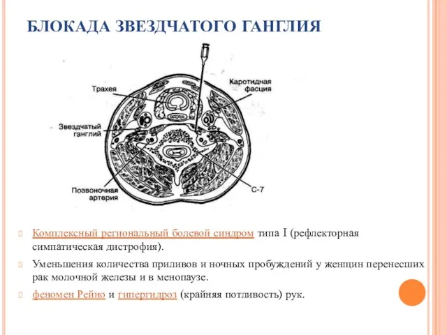 БЛОКАДА ЗВЕЗДЧАТОГО ГАНГЛИЯ Комплексный региональный болевой синдром типа I (рефлекторная