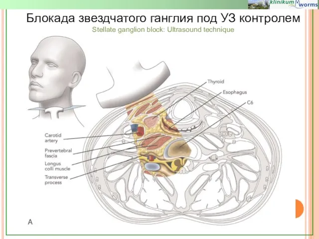 Блокада звездчатого ганглия под УЗ контролем Stellate ganglion block: Ultrasound technique