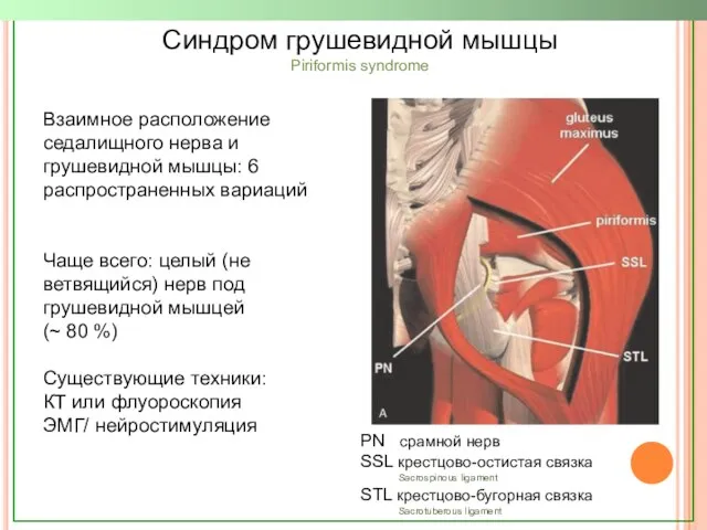 Синдром грушевидной мышцы Piriformis syndrome Взаимное расположение седалищного нерва и