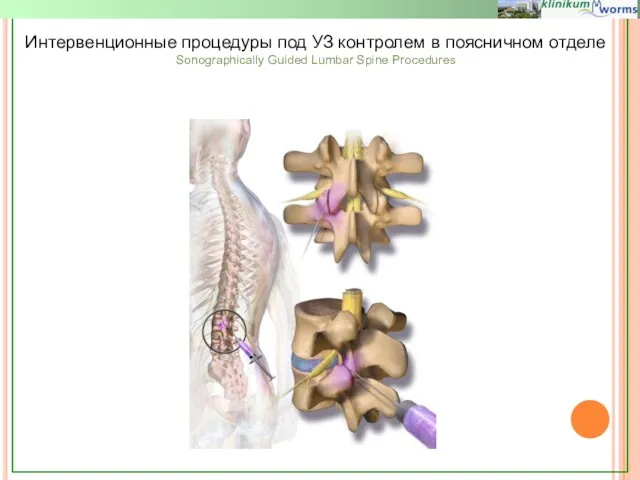 Интервенционные процедуры под УЗ контролем в поясничном отделе Sonographically Guided Lumbar Spine Procedures