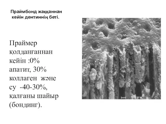 Праймбонд жаққаннан кейін дентиннің беті. Праймер қолданғаннан кейін :0% апатит,