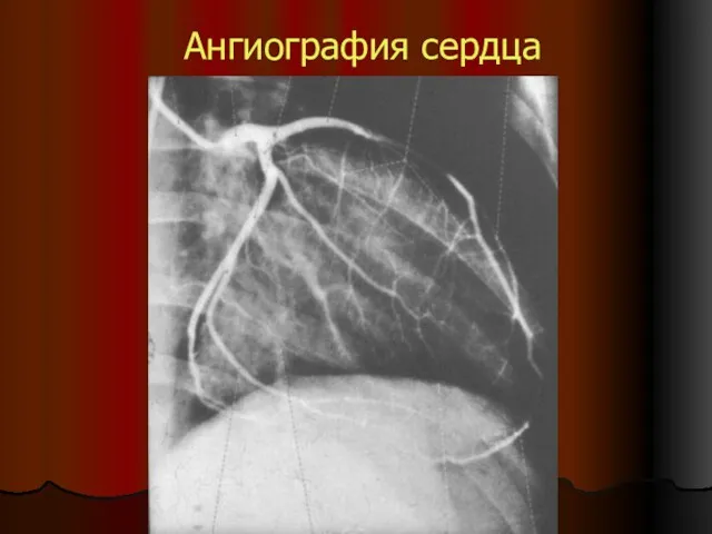 Ангиография сердца