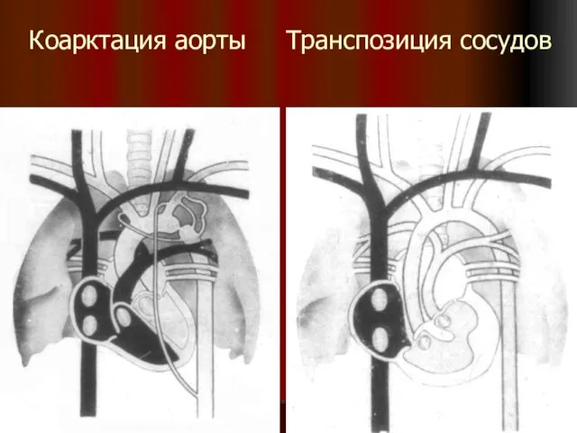 Коарктация аорты Транспозиция сосудов