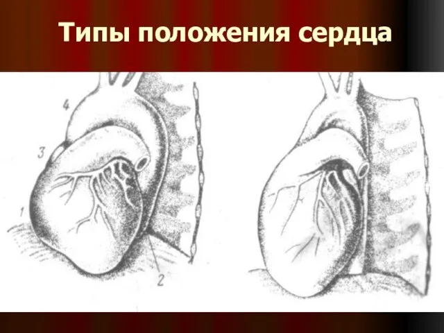 Типы положения сердца