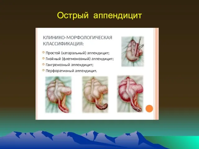 Острый аппендицит