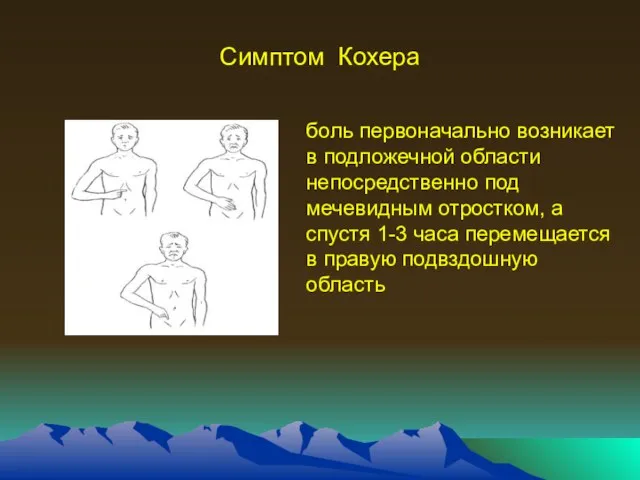 Симптом Кохера боль первоначально возникает в подложечной области непосредственно под