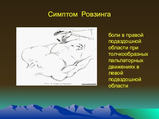 Симптом Ровзинга боли в правой подвздошной области при толчкообразных пальпаторных движениях в левой подвздошной области