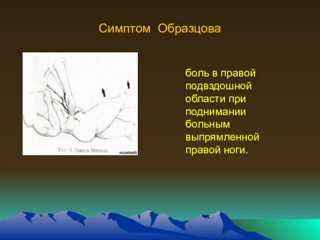 Симптом Образцова боль в правой подвздошной области при поднимании больным выпрямленной правой ноги.