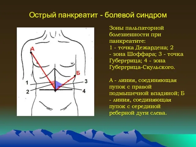 Острый панкреатит - болевой синдром Зоны пальпаторной болезненности при панкреатите: