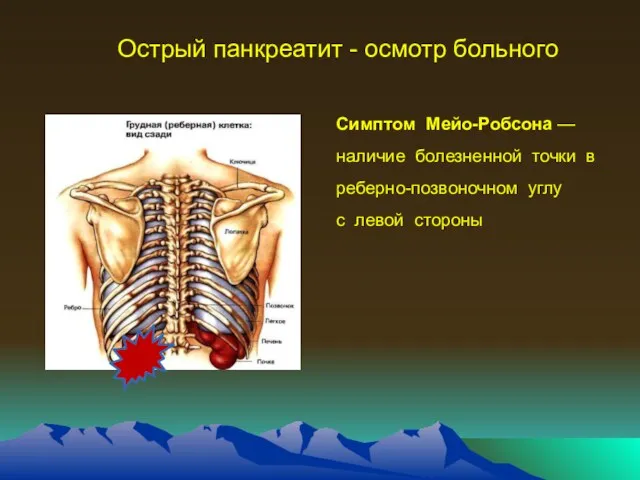 Острый панкреатит - осмотр больного Симптом Мейо-Робсона — наличие болезненной