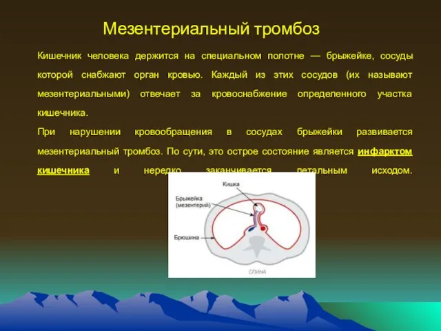 Мезентериальный тромбоз Кишечник человека держится на специальном полотне — брыжейке,