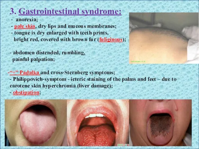 3. Gastrointestinal syndrome: - anorexia; - pale skin, dry lips