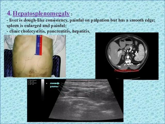 4. Hepatosplenomegaly : - liver is dough-like consistency, painful on