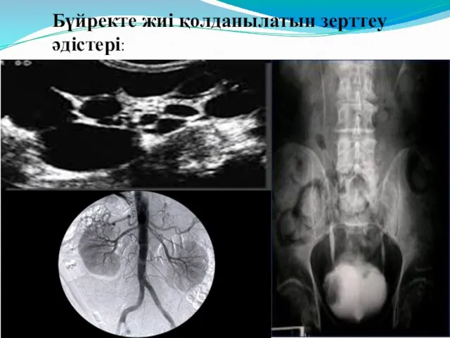 Бүйректе жиі қолданылатын зерттеу әдістері:
