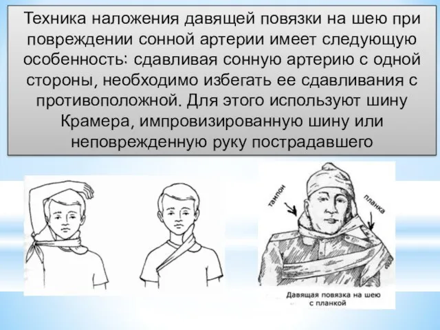 Техника наложения давящей повязки на шею при повреждении сонной артерии