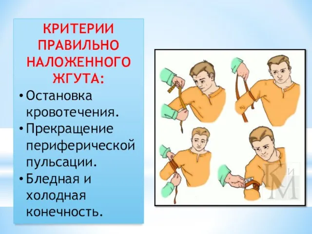 КРИТЕРИИ ПРАВИЛЬНО НАЛОЖЕННОГО ЖГУТА: Остановка кровотечения. Прекращение периферической пульсации. Бледная и холодная конечность.