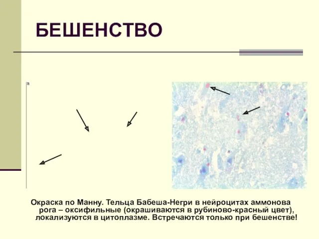 БЕШЕНСТВО Окраска по Манну. Тельца Бабеша-Негри в нейроцитах аммонова рога