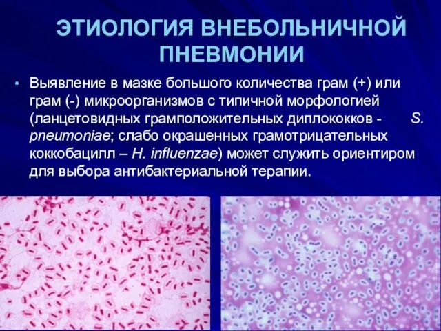 ЭТИОЛОГИЯ ВНЕБОЛЬНИЧНОЙ ПНЕВМОНИИ Выявление в мазке большого количества грам (+)