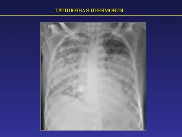 ГРИППОЗНАЯ ПНЕВМОНИЯ