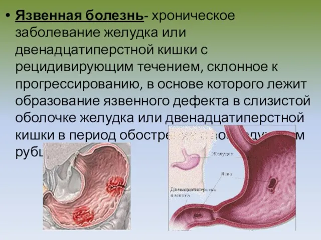 Язвенная болезнь- хроническое заболевание желудка или двенадцатиперстной кишки с рецидивирующим