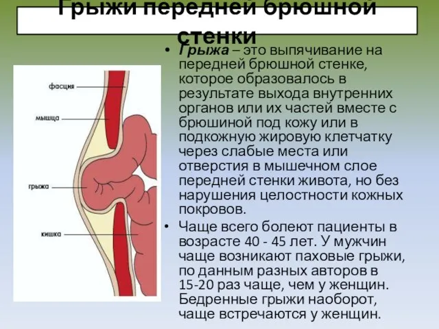 Грыжи передней брюшной стенки Грыжа – это выпячивание на передней